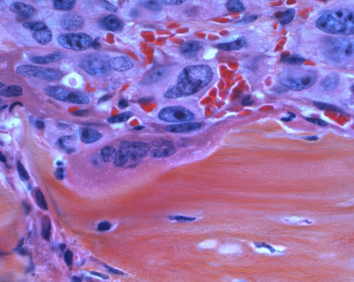 Photo Pancreatic Cancer Symptoms