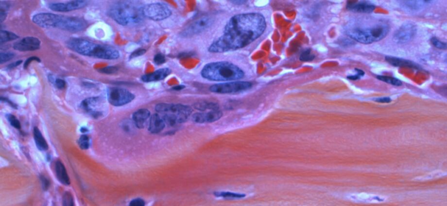 Photo Pancreatic Cancer Symptoms