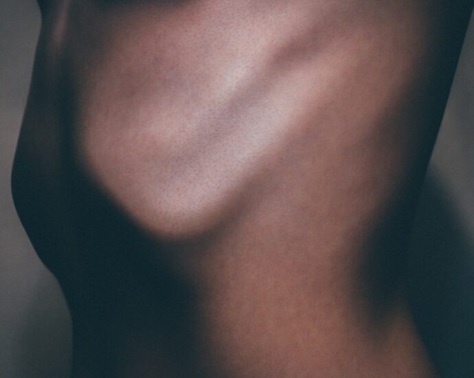 Photo Chest Pain
