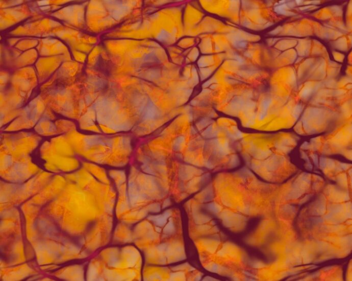 Photo sclerosis multiplex