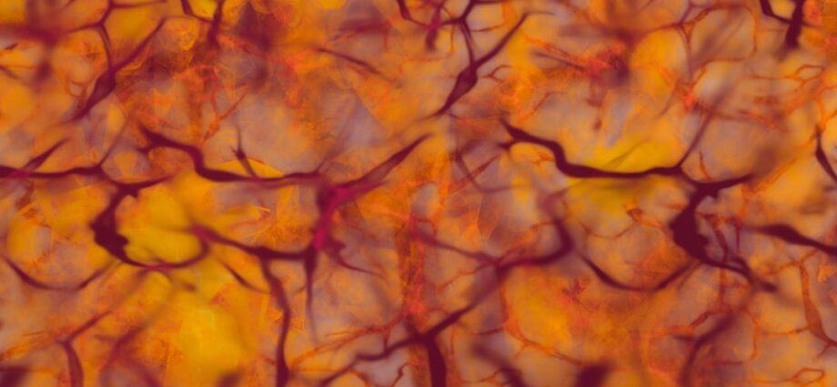 Photo sclerosis multiplex