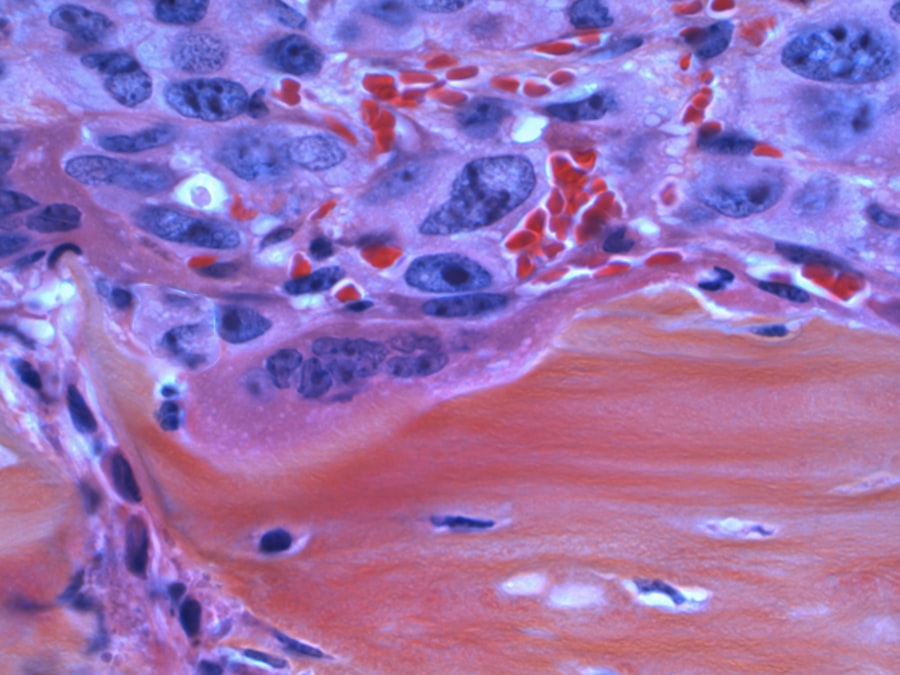 thyroid diseases