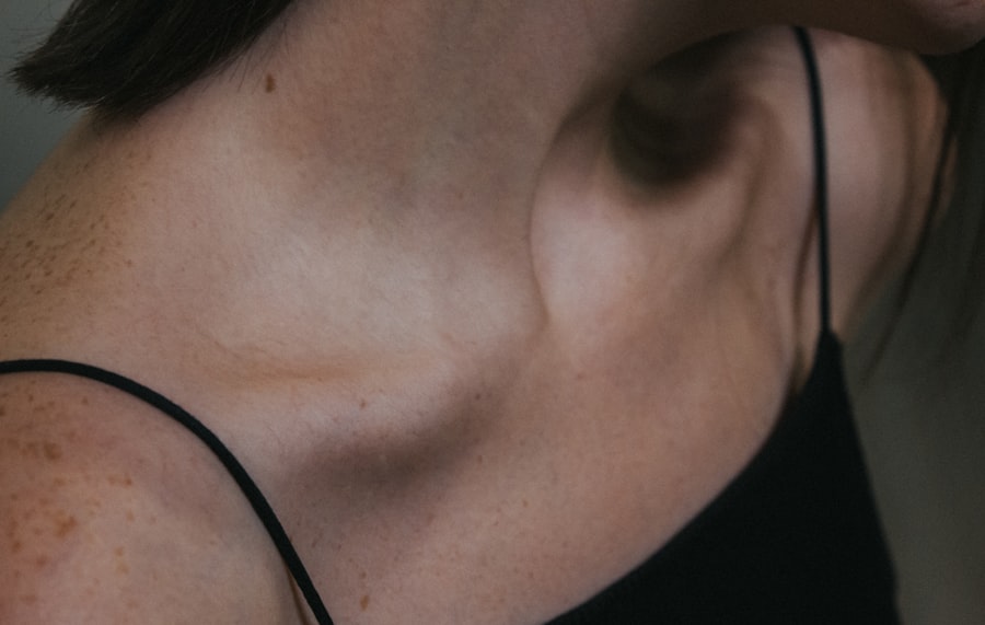 thyroidism