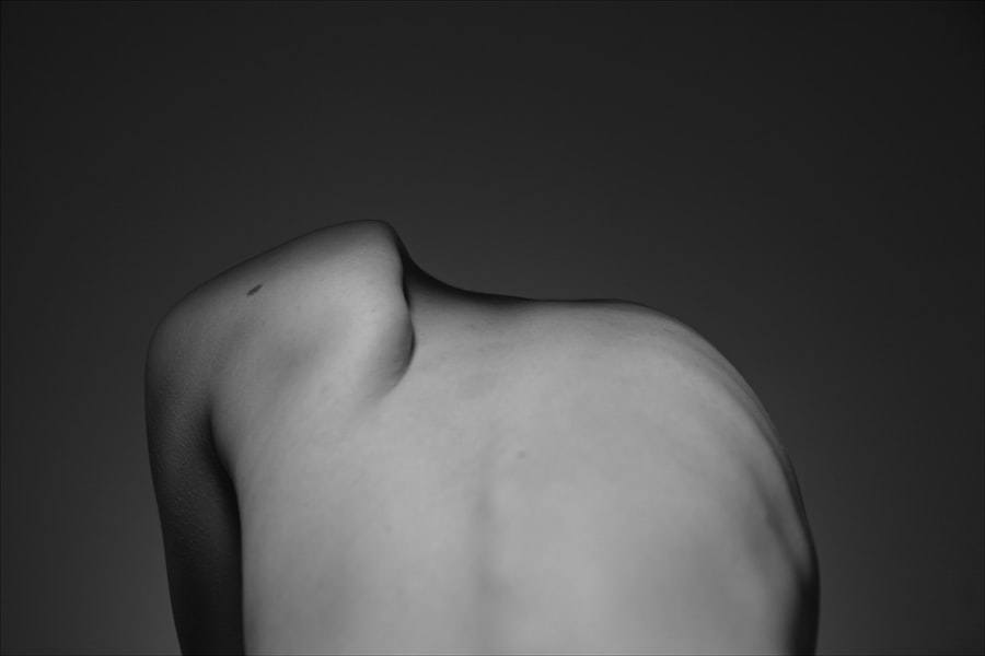 Photo thyroidism