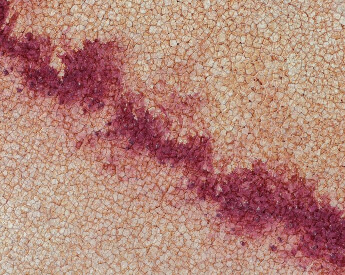 Photo hepatic diseases
