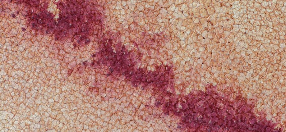 Photo hepatic diseases