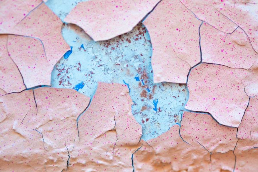Psoriasis