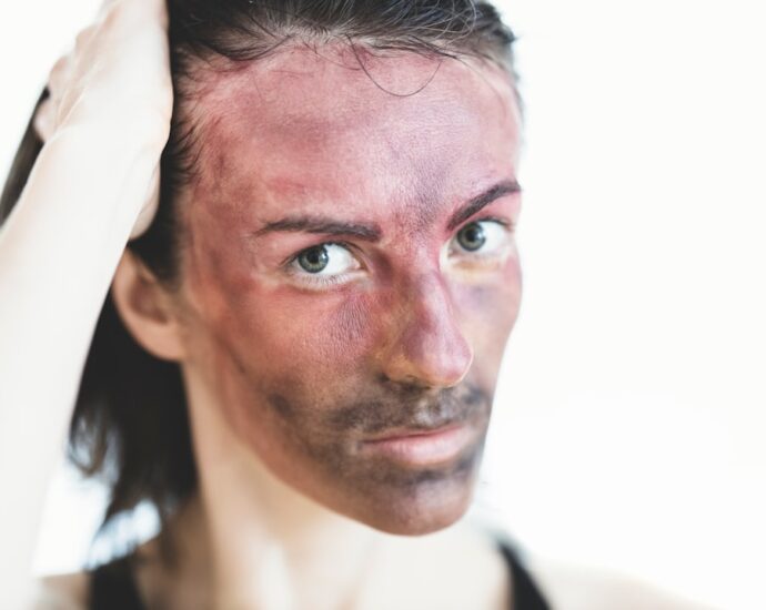 Photo Psoriasis