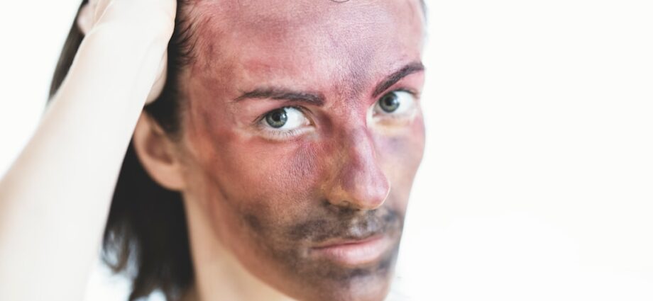 Photo Psoriasis