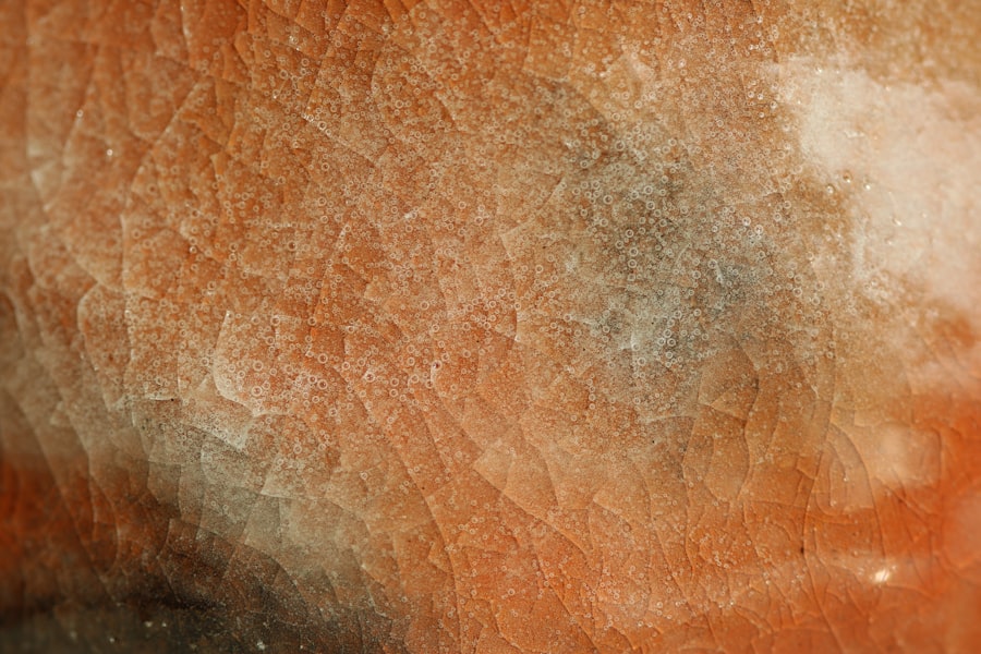 Photo Psoriasis